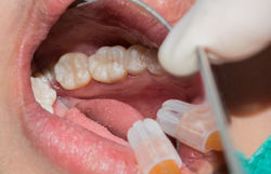 Amalgam Filling