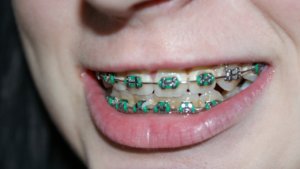 tooth braces